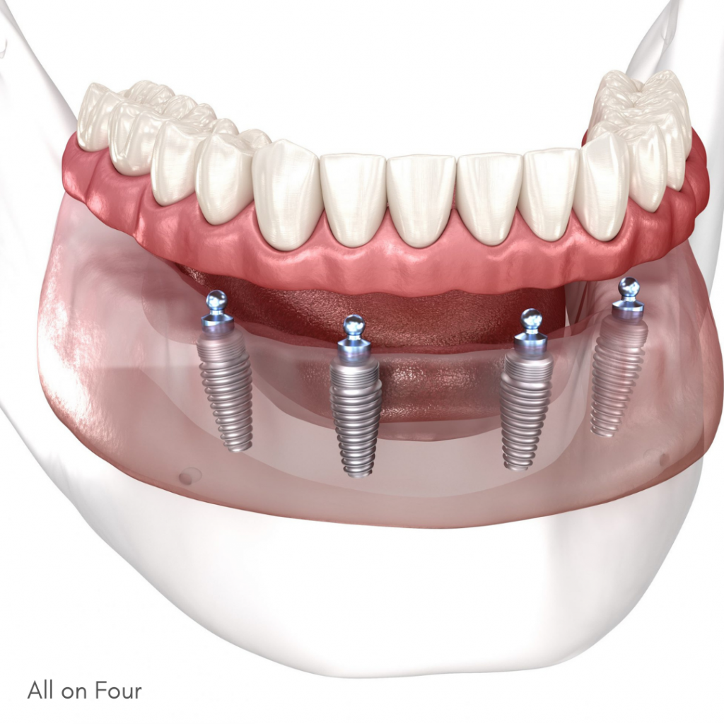 Illustration showing All-on-4 dental implants placed in the upper jaw.