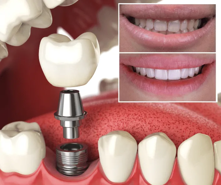 Can Implants Be Placed in a Week