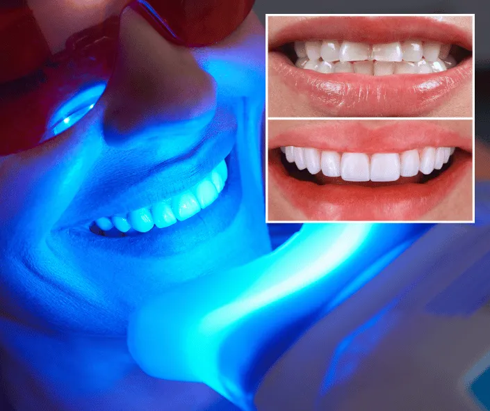 Can You Whiten Your Teeth Permanently