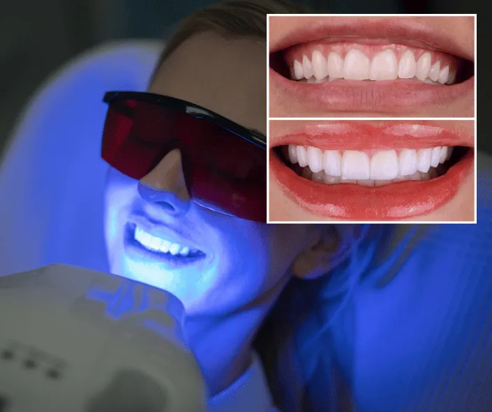 How Does a Whitening Session Take Place